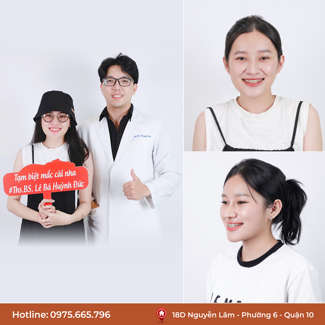 Tháo niềng răng cùng bác sĩ Huỳnh Đức tại Home Dentist